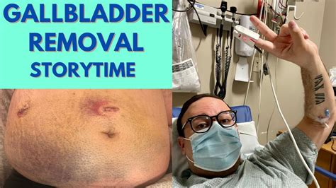 Overcoming Unexpected Challenges After Gallbladder Removal